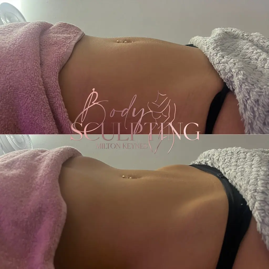 Body Sculpting Milton Keynes