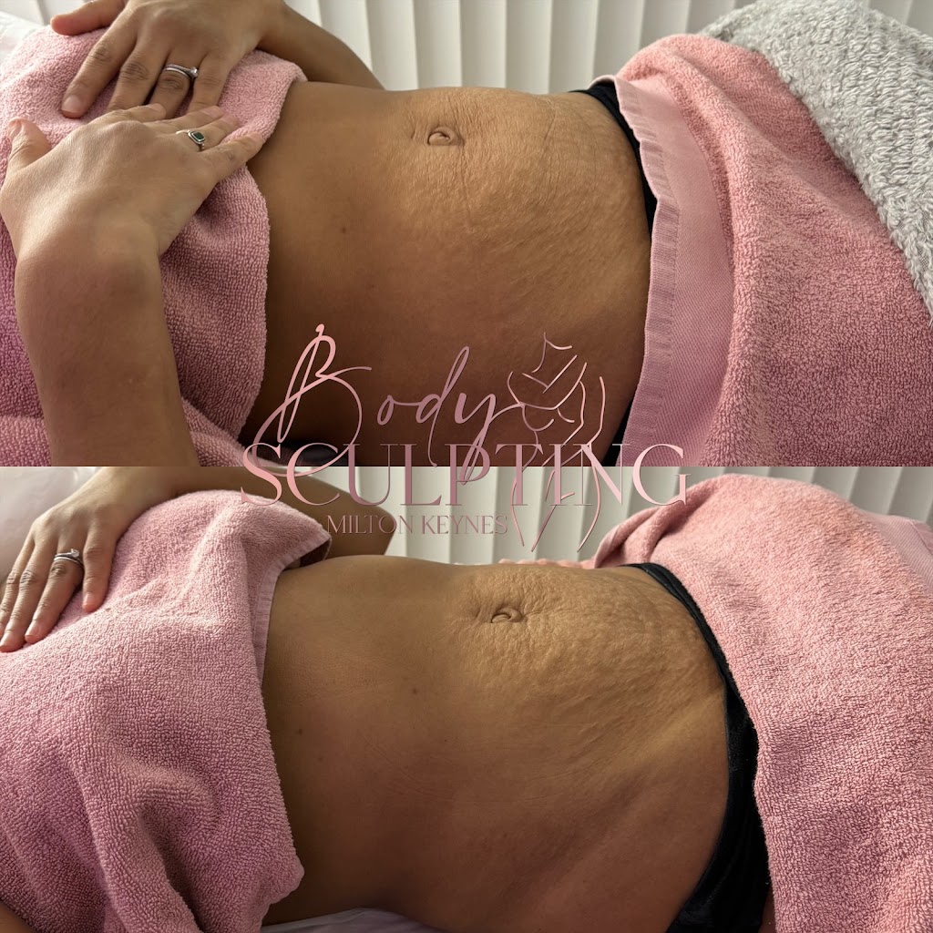 Body Sculpting Milton Keynes Photo
