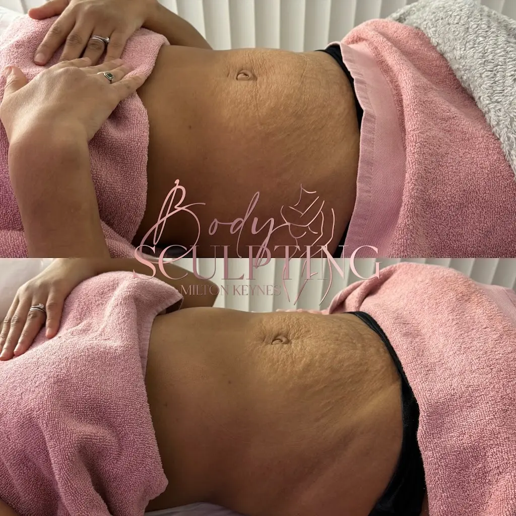 Body Sculpting Milton Keynes Photo