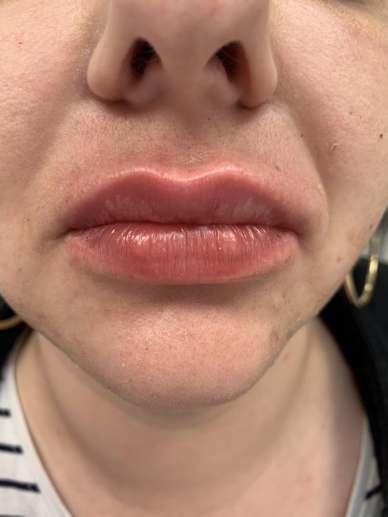 CA Cosmetic and Aesthetics Limited – Lemon Bottle Training – Pathway to Aesthetics – Lip Masterclass