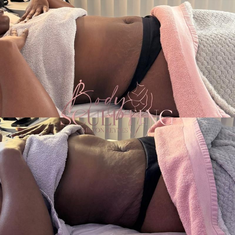 Body Sculpting Milton Keynes