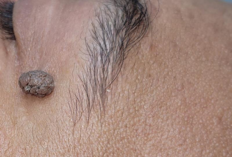 a.h.advanced skin specialist/ Skin Tag and Blemish Removal